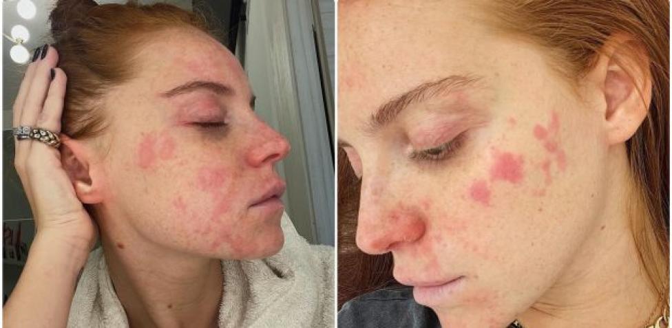 accutane in italiano