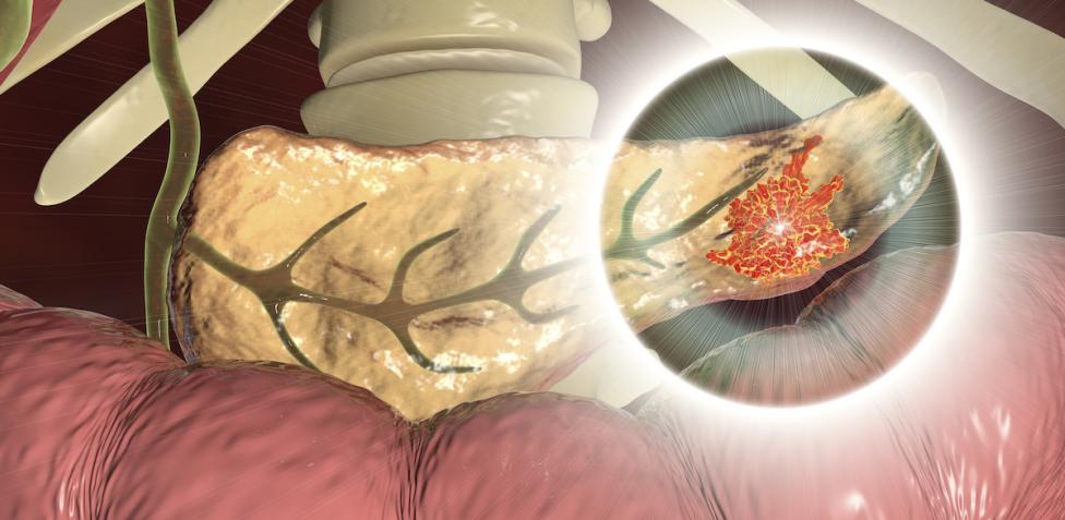 Tumore al pancreas: sintomi, diagnosi e cura della malattia di Vialli