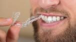 Bite dentale come e quando usarlo