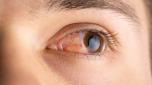 Male with ill eyes. Concept of conjunctivitis