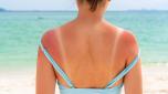 Sunburned skin on shoulder and back of a woman because of not using cream with sunscreen protection. Red skin sun burn after Sunbathing at the beach. Summer and holiday concept. Close up