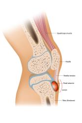 Osgood Schlatter disease or OSD is inflammation of the patellar ligament at the tibial tuberosity Apophysitis