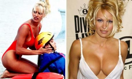 Il boom di interventi di mastoplastica additiva si è registrato alla fine degli anni 90, "colpa" anche di Baywatch e di una delle sue protagoniste, Pamela Anderson