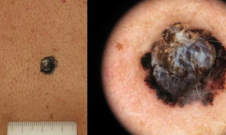 melanoma invasivo immagine