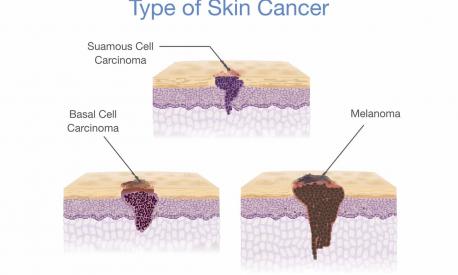 tumore della pelle prevenzione e cura