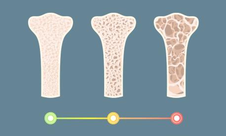 Le fasi osteoporosi