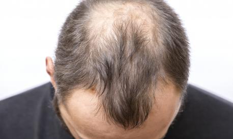 Balding young man, Hair loss problem