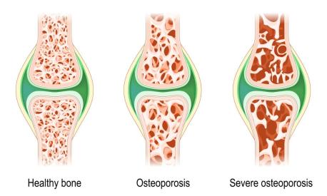 Stadi Osteoporosi cause e fattori di rischio