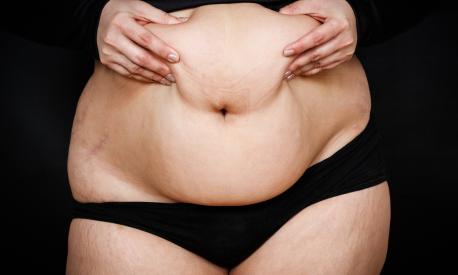 Obesità: come funziona la chirurgia plastica post bariatrica