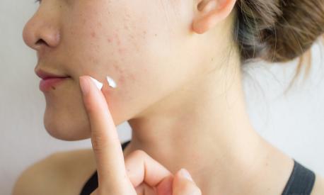 Shot of woman preparing for applying acne cream for solve her problem skin.