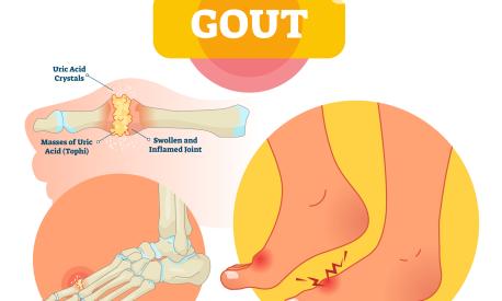 Gout vector illustration. Medical labeled scheme with uric acid crystals, masses of tophi. Diagnosis of swollen and inflamed foot joint. Painful anatomical bone disease.
