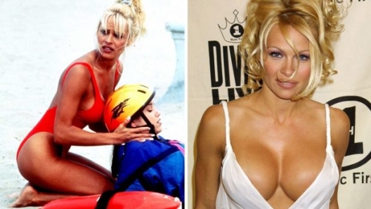 Il boom di interventi di mastoplastica additiva si è registrato alla fine degli anni 90, "colpa" anche di Baywatch e di una delle sue protagoniste, Pamela Anderson