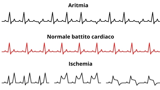 Differenza aritmia ischemia e battito normale