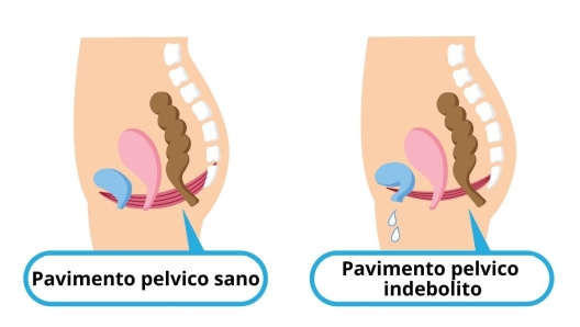 Pavimento pelvico sano e indebolito