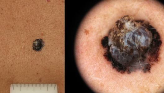 melanoma invasivo immagine