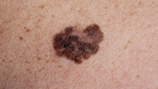 melanoma maligno