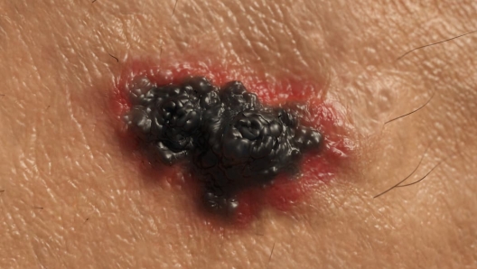 melanoma nodulare