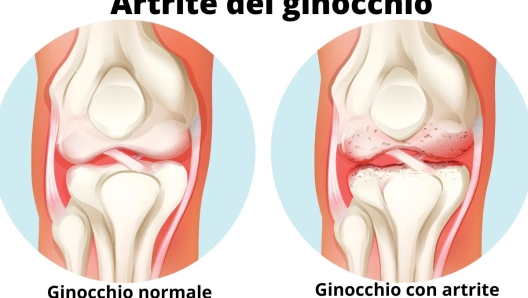 Ginocchio con artrite