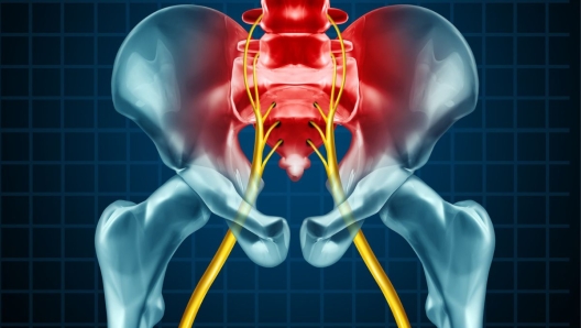 Infiammazione nervo sciatico