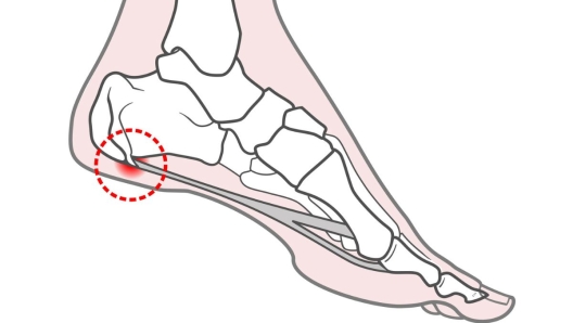 Sperone calcaneare come è fatto