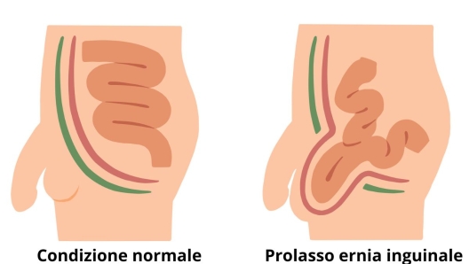Ernia inguinale uomo intervento e rimedi