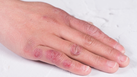 close up of female hand with chilblain on table