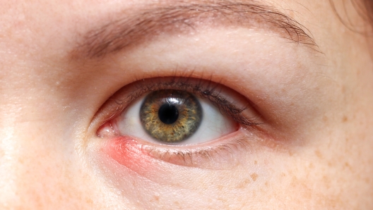 Inflammation, redness in the lower eyelid. Chalazion gordolum. Girl's eye close up.