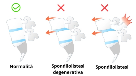 Spondilolistesi sintomi