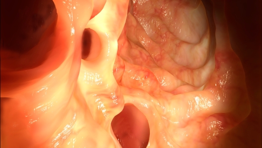 Diverticula in the colon