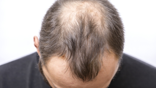 Balding young man, Hair loss problem