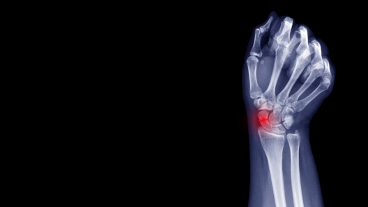 Scaphoid bone fracture