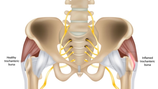 Trocanterite dolore anca durante corsa