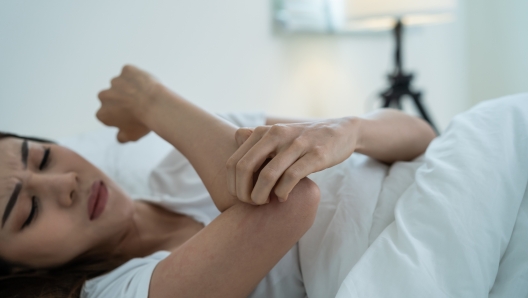 Asian young woman scratch hand feel suffer from allergy while sleeping. Beautiful attractive girl lying on bed in bedroom suffering from itching arm skin allergic reaction to insect bites, dermatitis.