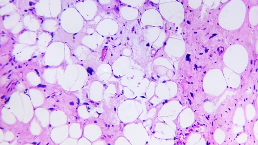 Liposarcoma of a human, photomicrograph panorama as seen under the microscope, 200x zoom.