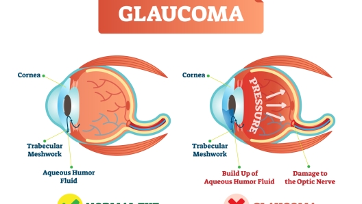 Glaucoma