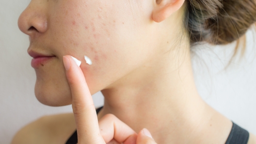 Shot of woman preparing for applying acne cream for solve her problem skin.