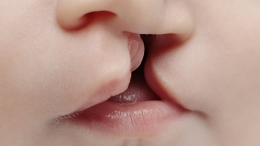 Close up on the lips of baby with lip and palate cleft before surgery.