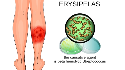 Erisipela immagini dei batteri responsabili