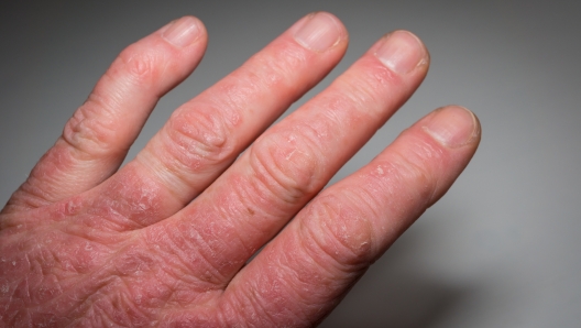 Hand of a psoriasis patient close-up. Psoriatic arthritis. Joint deformation and inflammation on the skin. Photo with dark vignetting.Soft focus.