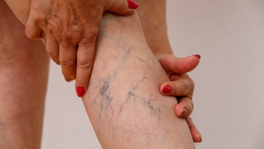 varicose veins of eldelry woman.