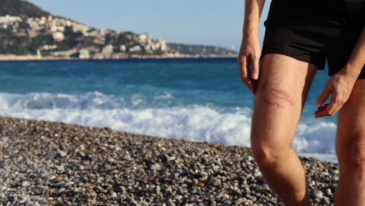 A jellyfish sting burn on a man's leg, on the beach