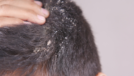 men with dandruff in his hair, closeup .