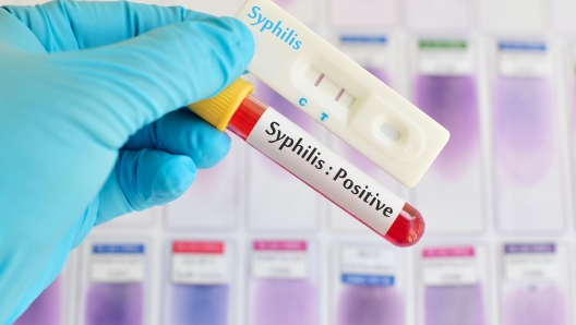 Syphilis testing positive by using cassette test