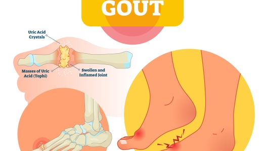 Gout vector illustration. Medical labeled scheme with uric acid crystals, masses of tophi. Diagnosis of swollen and inflamed foot joint. Painful anatomical bone disease.