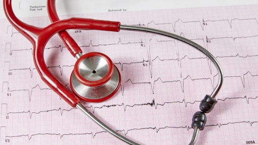 Ecocardiography report (ECG) showing irregular heartbeat with  a red stethoscope on top of it