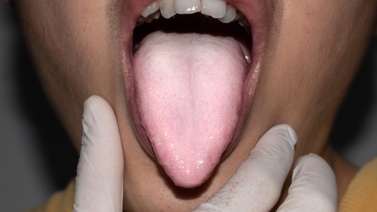 Coated tongue or white tongue of Asian, Chinese man. It appears with white layer when debris, bacteria and dead cells become lodged between enlarged papillae. Loss of taste called ageusia.