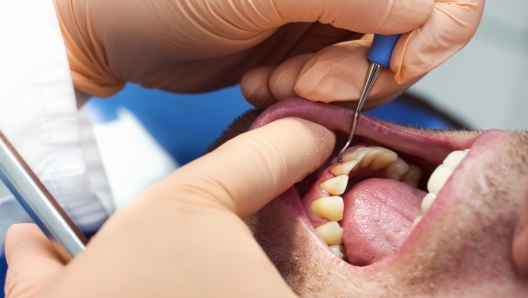 Dentist hands with tools and  patient with parodontosis in a dental clinic