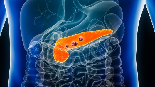 Ricerca San Raffaele tumore al pancreas terapie