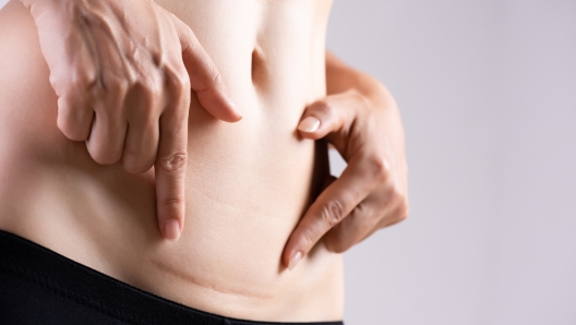 Closeup of woman showing on her belly dark scar from a cesarean section. Healthcare concept.