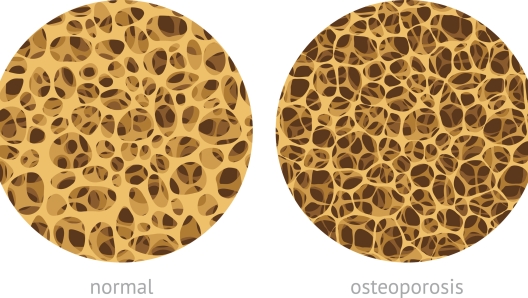 Bone spongy structure vector illustration, normal and with osteoporosis